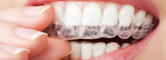 Esthetische tandheelkunde - bleachen - facings
