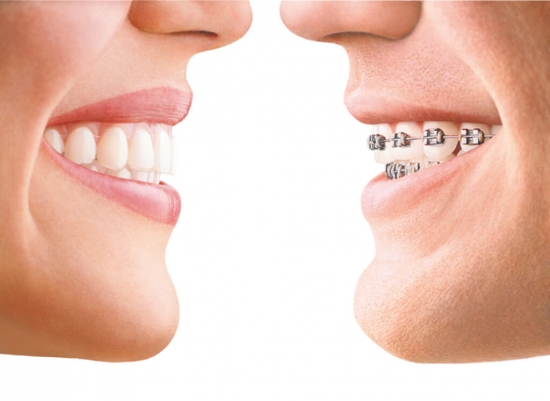 Invisalign - clear aligners - onzichtbare beugel - orthodontie - blokjes - ClearCorrect - SureSmile Dentsply